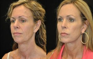 49 year old female patient facial rejuvenation (facelift &#038; facial fat grafting) before &#038; after pictures