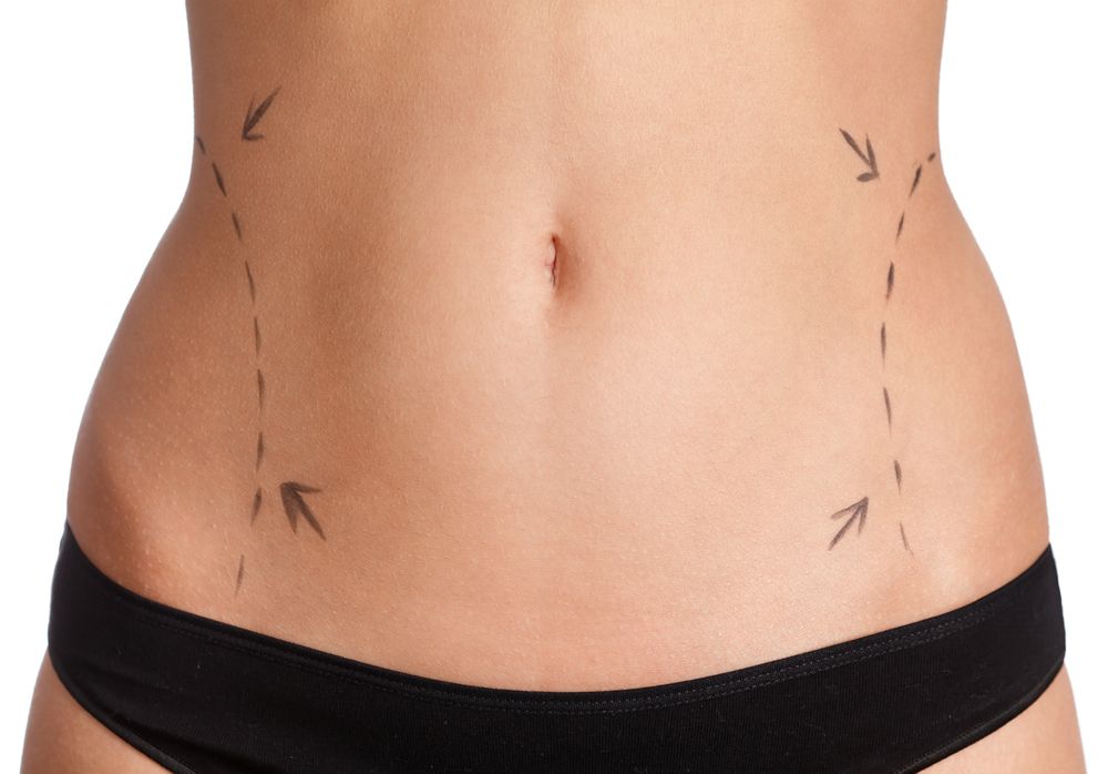 Laser Liposuction vs. Tummy Tuck Surgery, Beverly Hills