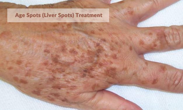 What are Age Spots? How Can You Treat Them?