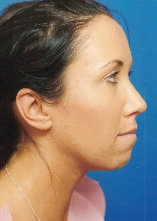 Chin Implant case #4176