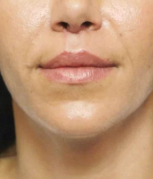 _0003_case-2-7-lip-augmentation-view-1-2.webp