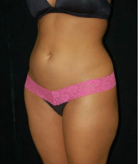 Liposuction case #4664