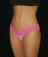 Liposuction case #4664