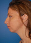 Chin Implant case #4183