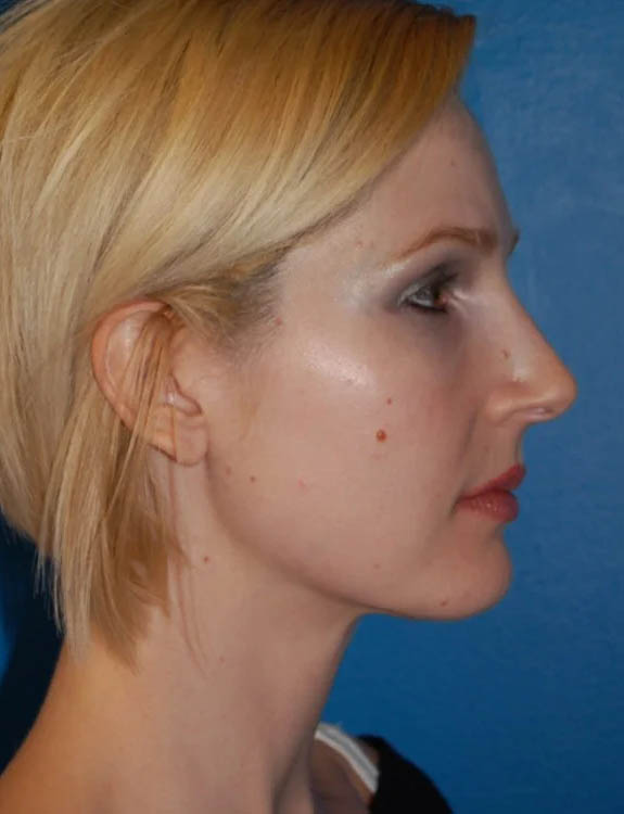 Neck Liposuction case #4930