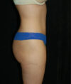 Liposuction case #4671