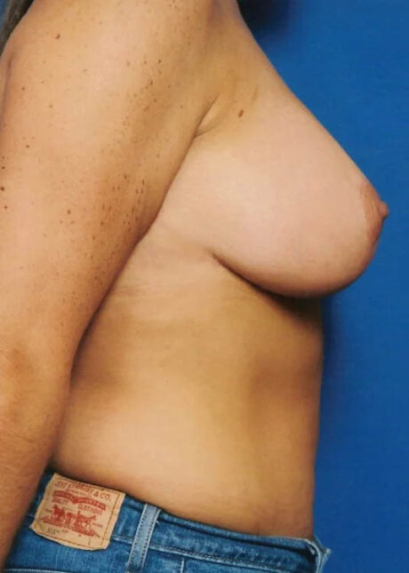 Breast Lift case #3968