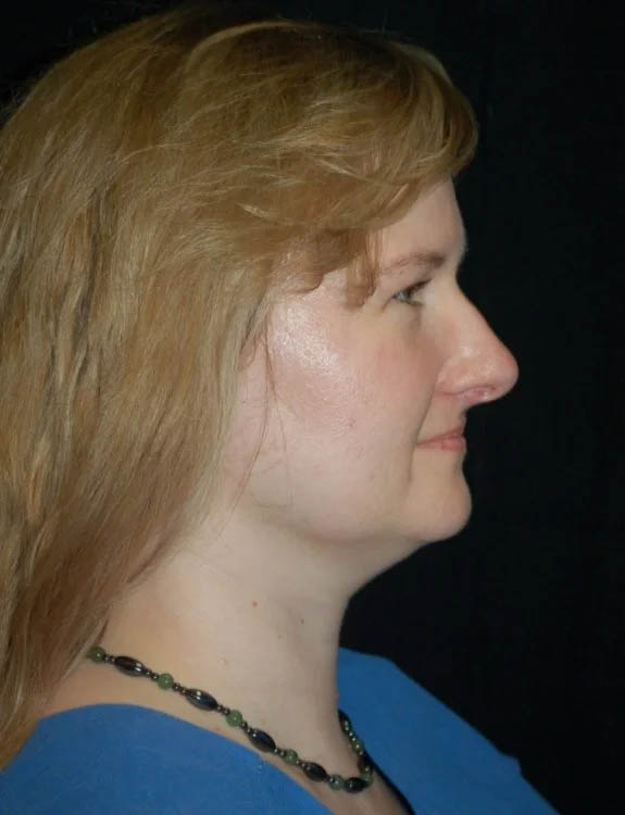 Neck Liposuction case #4935