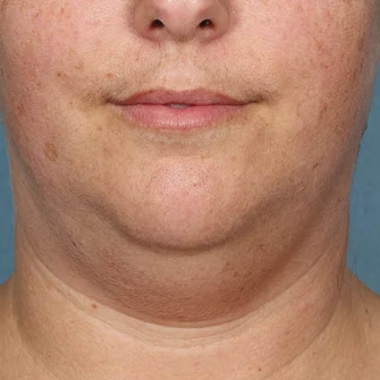 Kybella case #4634