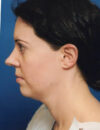 Neck Liposuction case #4938