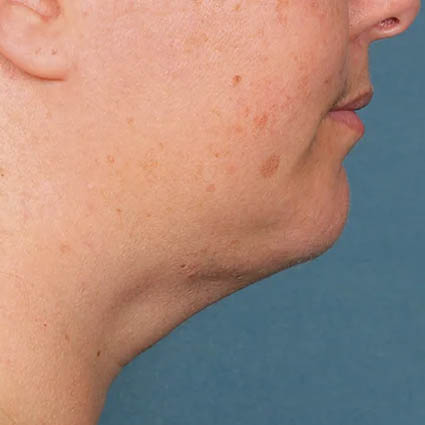 Kybella case #4634