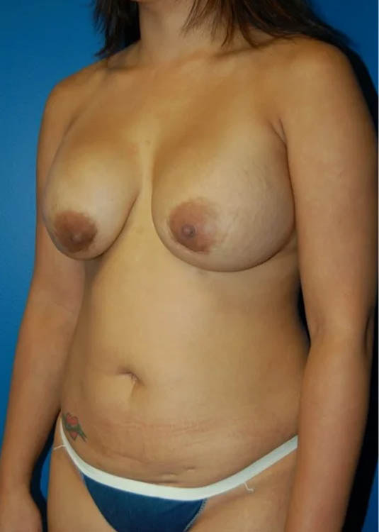 Revision Breast Augmentation with Benelli Lift case #3890