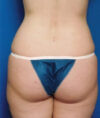 Liposuction case #4685