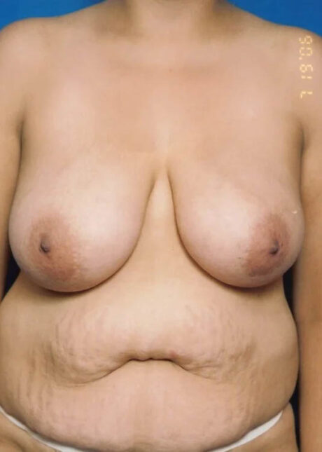 Breast Lift case #3982