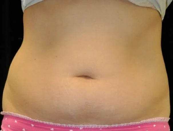 Coolsculpting case #4316