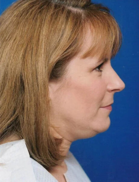 Neck Liposuction case #4946