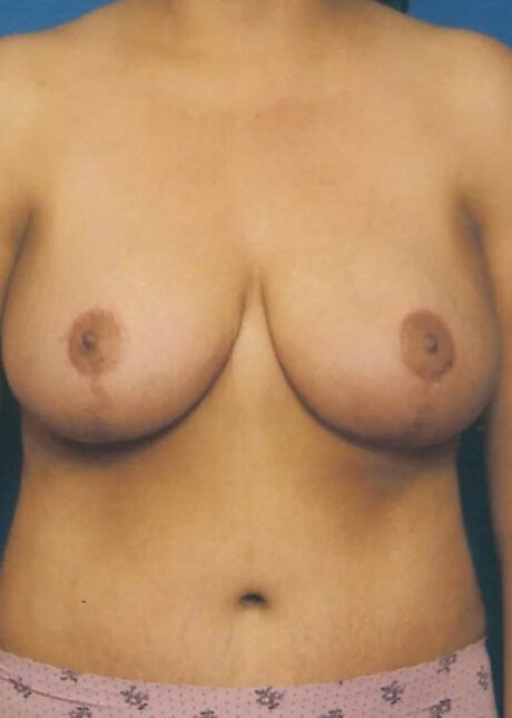 Breast Lift case #3982