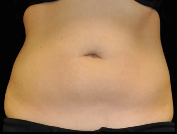 Coolsculpting case #4316