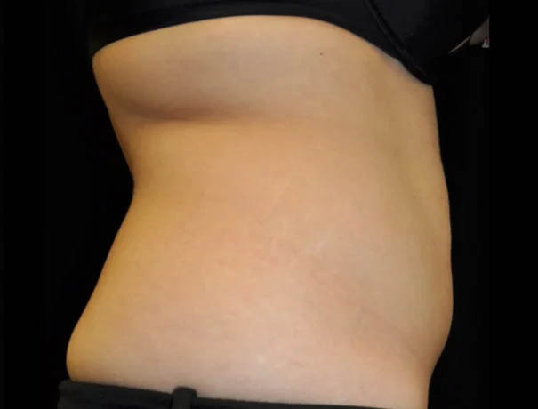 Coolsculpting case #4316