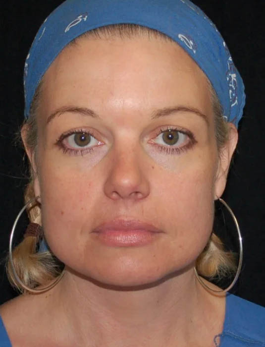 Facial Fat Grafting case #4509