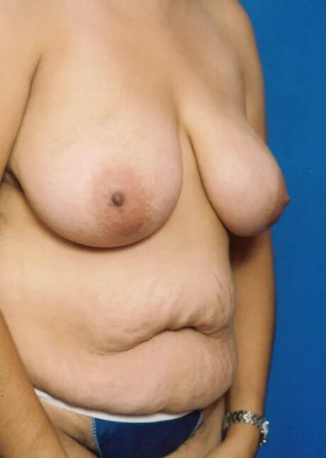 Breast Lift case #3982