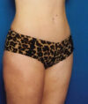 Liposuction case #4685