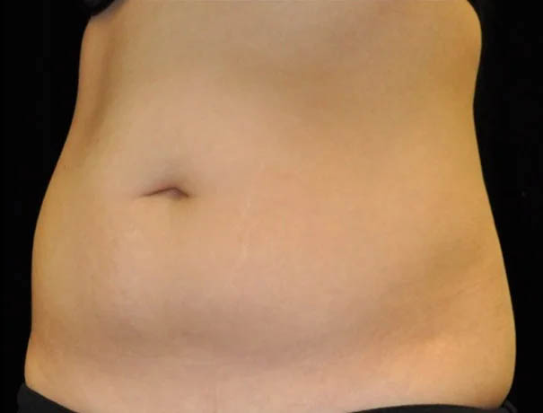 Coolsculpting case #4316