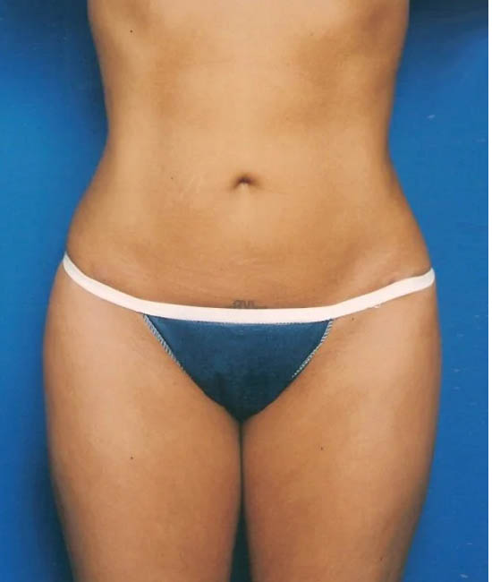 Liposuction case #4699