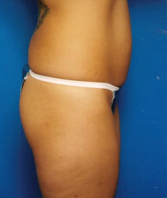 Liposuction case #4699