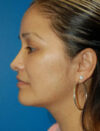 Facial Fat Grafting case #4527