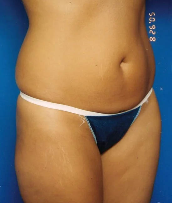 Liposuction case #4699