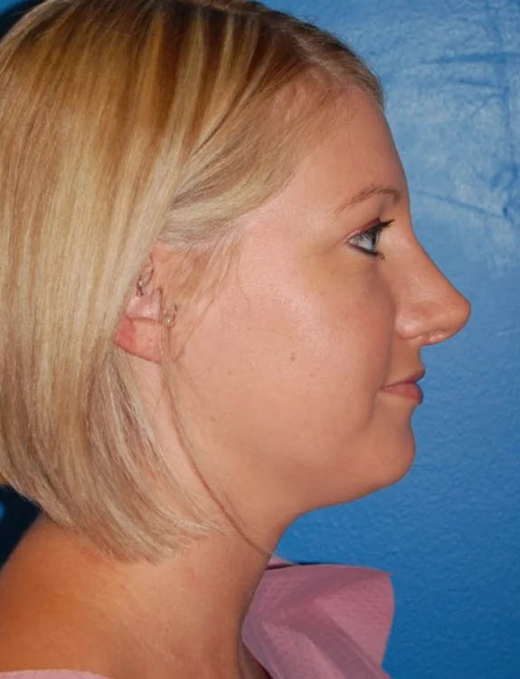 Neck Liposuction case #4970