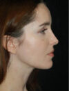 Facial Fat Grafting case #4532