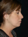 Neck Liposuction case #4973