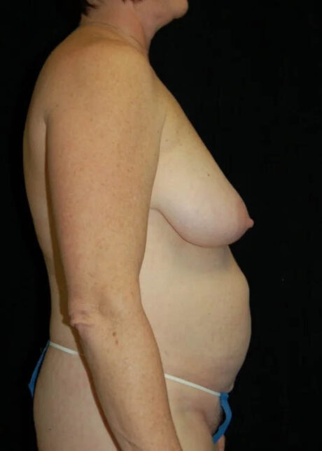 Breast Lift case #4003