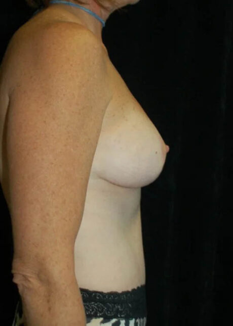 Breast Lift case #4003