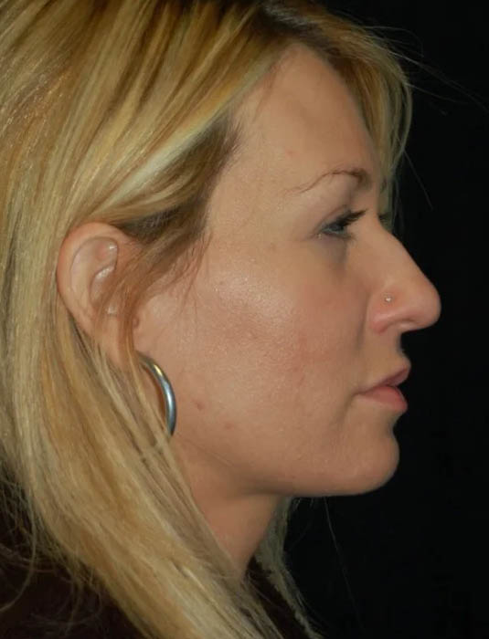 Facial Fat Grafting case #4537