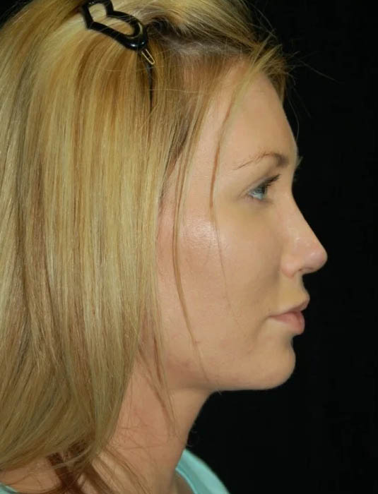 Facial Fat Grafting case #4537