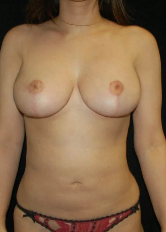 _0043_case-8-13-breast-lift-view-1-2.webp