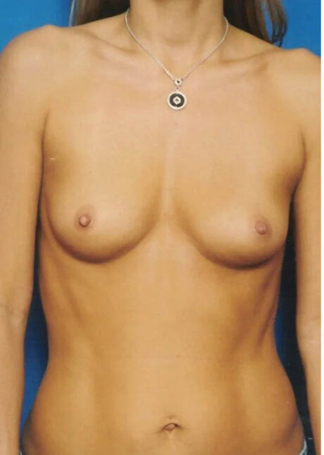 Breast Augmentation case #3675