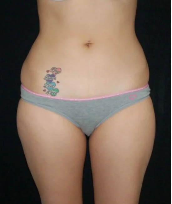 Liposuction case #4729