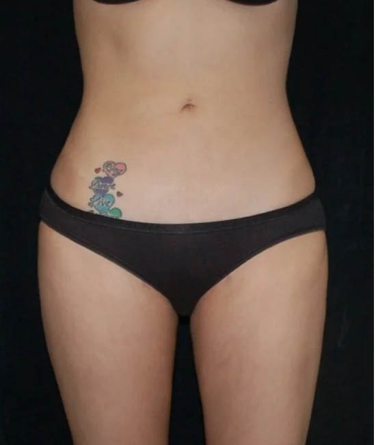 Liposuction case #4729