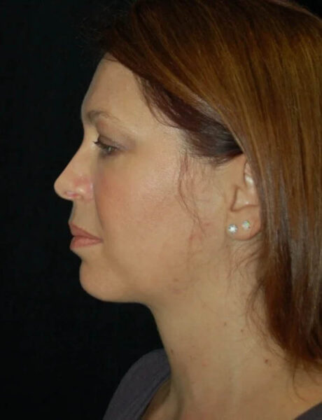 Neck Liposuction case #4992