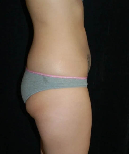 Liposuction case #4729