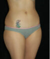 Liposuction case #4729