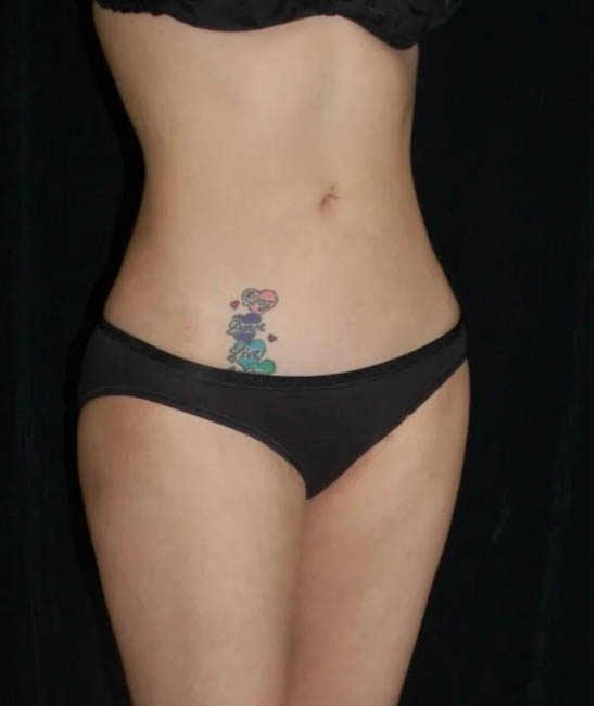 Liposuction case #4729