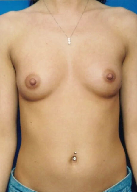 Breast Augmentation case #3692