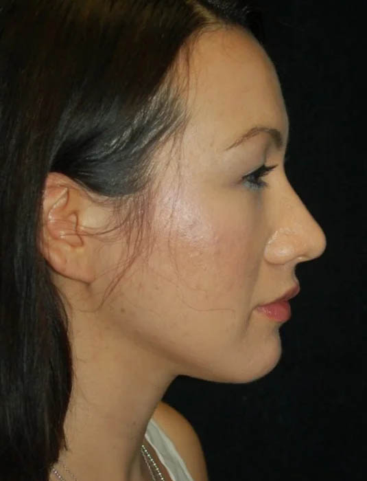 Facial Fat Grafting case #4568