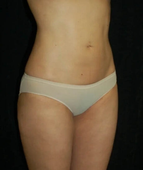 Liposuction case #4736