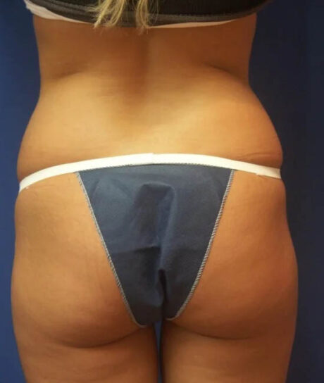 Liposuction case #4743